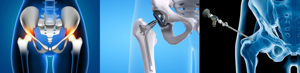 Hip Replacement​