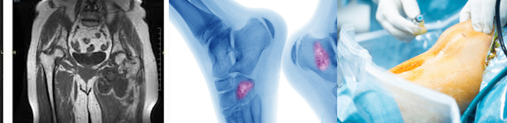 Orthopedic oncology