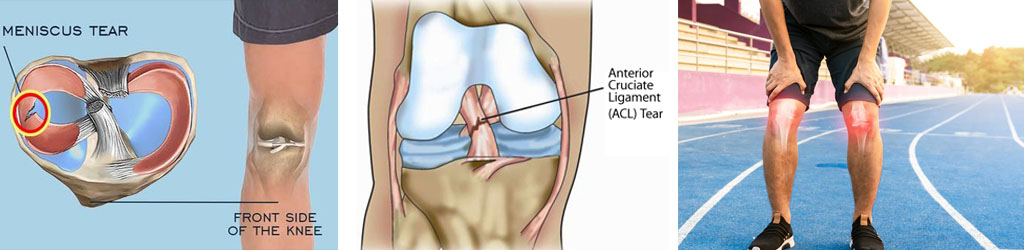 Sport Injuries