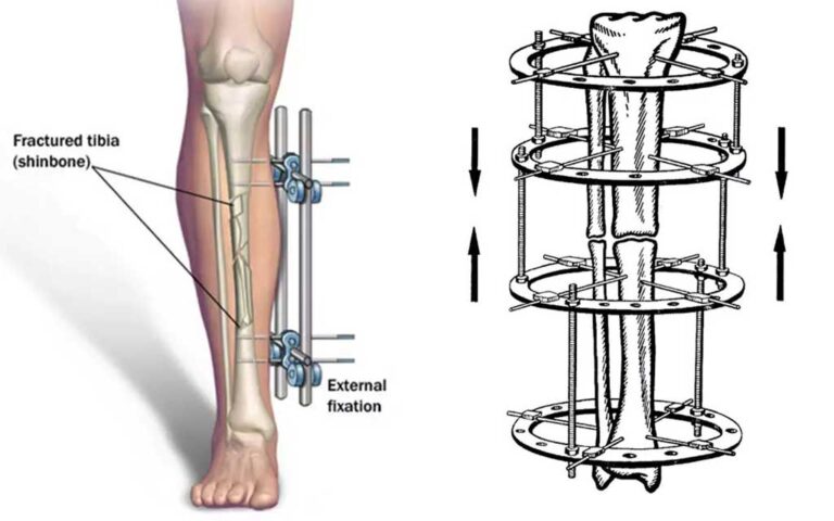 Ilizarov Surgery
