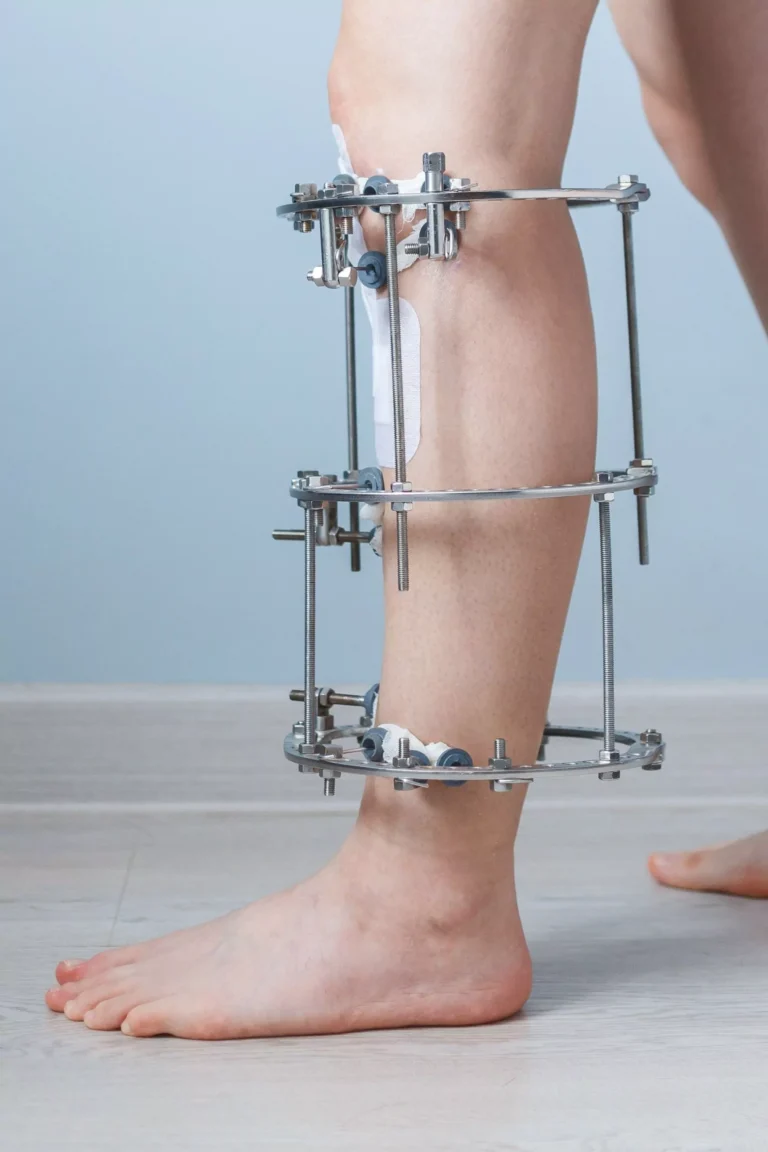 Ilizarov Surgery